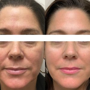 ACUPUNTURA ESTÈTICA I LIFTING FACIAL